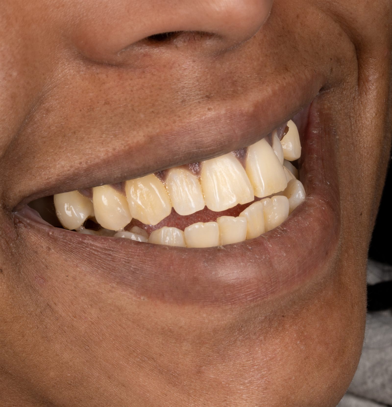 Full-Mouth — Before
